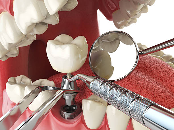 Best Emergency Wisdom Tooth Extraction in Crystal Lake, CT